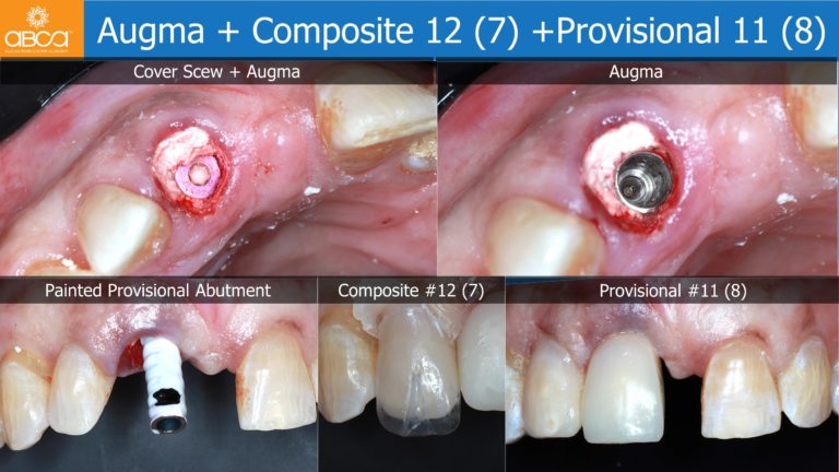 Immediate Loading in the Aesthetic Zone of Tooth 